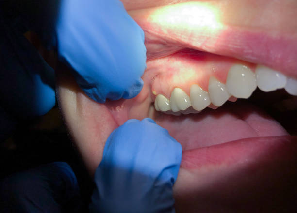 Best Cracked Tooth Emergency Dentist  in Somersworth, NH